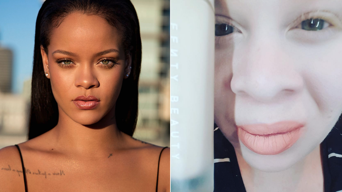 Rihanna’s Fenty Beauty Collection Just Helped A Woman With Albinism Find Her Perfect Foundation Match